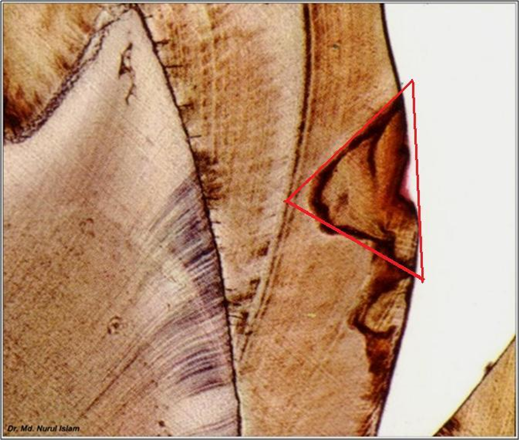 <p>what kind of enamel caries is this?</p>