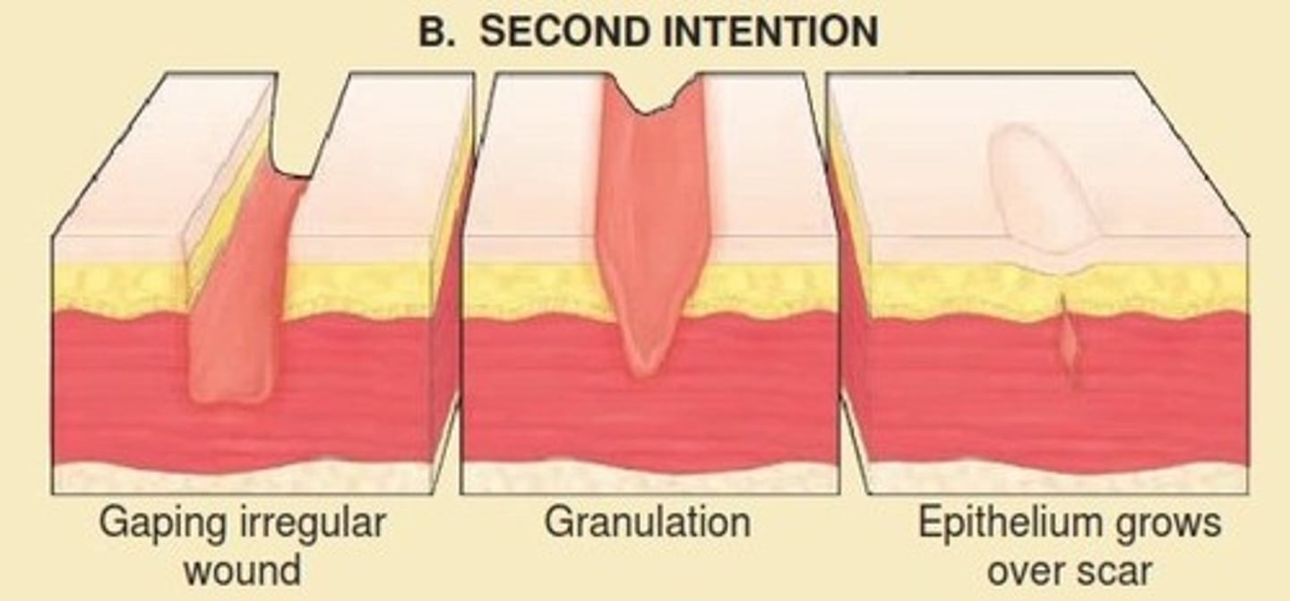<p>This method is used when wound edges cannot be approximated (e.g., a large crater or "pothole"). The body must build a matrix of granulation tissue to fill the wound defect. Healing occurs through a combination of granulation, wound contraction, and epithelialization from the wound periphery. Where PTs spend most of wound care.</p>