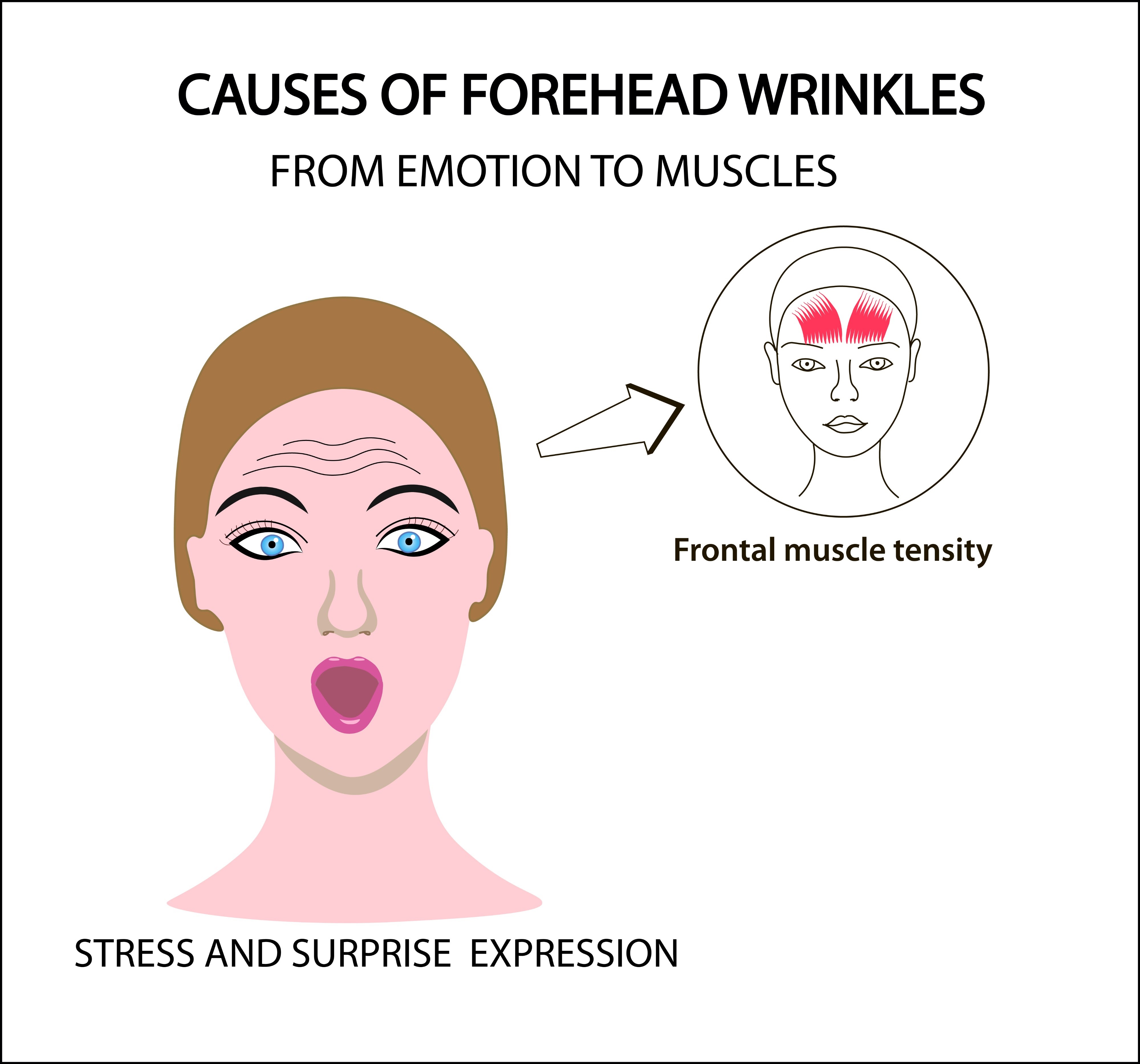 <ul><li><p>Muscle: <span style="color: rgb(197, 255, 192);"><strong><u>occipitofrontalis (frontalis)</u></strong></span></p></li></ul><ul><li><p><span style="color: rgb(197, 255, 192);"><strong>Raises the eyebrows</strong> (elevation).</span></p></li><li><p><span style="color: rgb(197, 255, 192);"><strong>Wrinkles the forehead</strong> (creating horizontal furrows).</span></p></li></ul><p>It is a key muscle for conveying expressions like <span style="color: rgb(197, 255, 192);"><strong>surprise</strong> or <strong>concentration</strong>.</span></p>