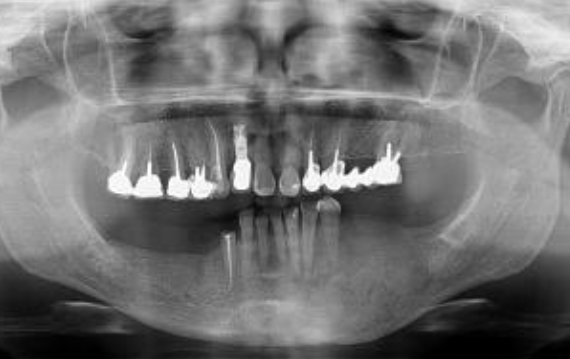 <p>Mixed</p><p>ground glass look</p><p>borders blend into surrounding bone</p><p>loss of lamina dura</p><p>often unilateral expansion&nbsp;</p>