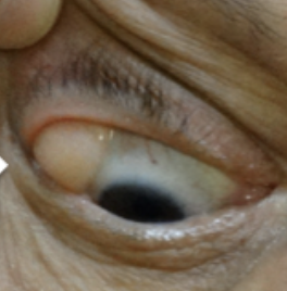 <p>Abnormal Finding for<em> </em><strong><em>8. Inspect lacrimal apparatus</em></strong></p><ul><li><p>May be visible in the lateral aspect of the upper eyelid</p></li><li><p>Caused by blockage, infection, or an inflammatory condition</p></li></ul><p></p>