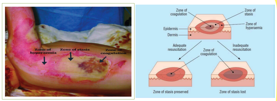 <ul><li><p>Zone of coagulation</p></li><li><p>Zone of stasis</p></li><li><p>Zone of hyperemia</p></li></ul><p></p>