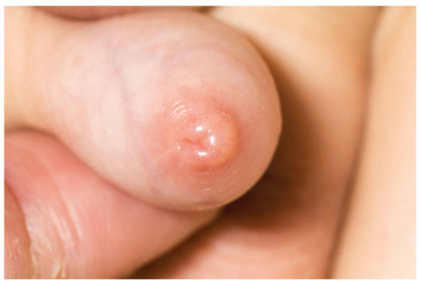 <p><span style="background-color: transparent;"><span>is a condition of the penis characterized by tight </span><u><span>foreskin</span></u><span> that cannot be pulled back over the glans penis</span></span></p>