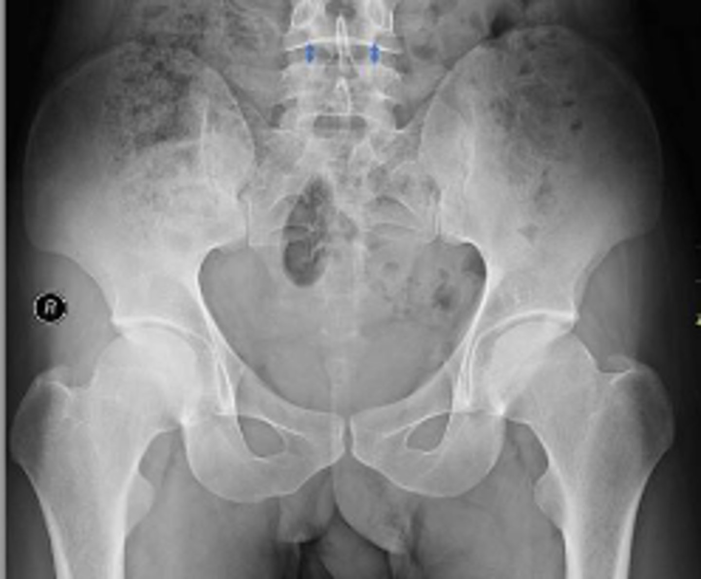 <p>Which IVD space is indicated by the arrows?</p>