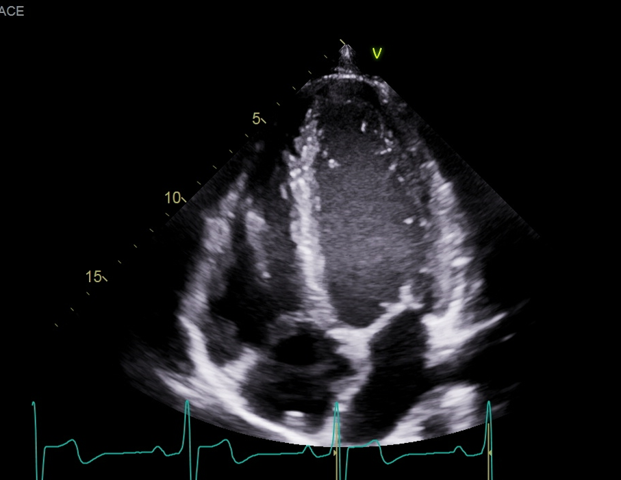 <p>Obtain and hold apical 4 chamber view</p>