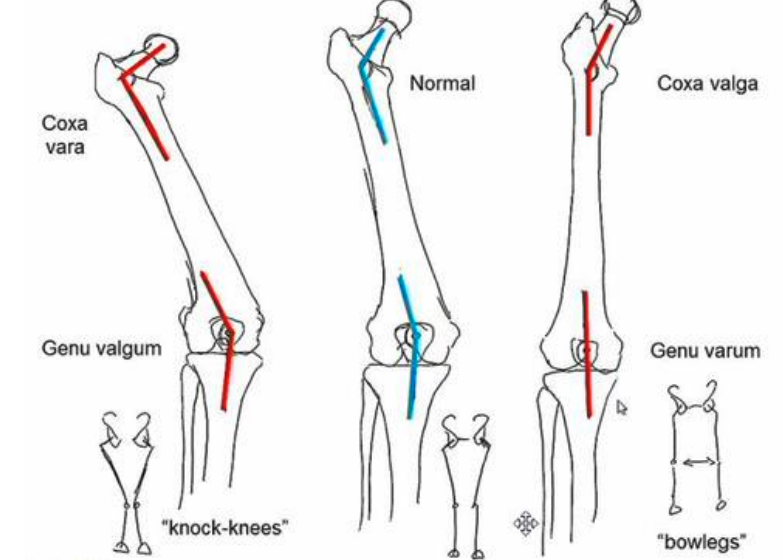 <p>an angulation of a distal segment towards the midline of the body relative to the normal ranges </p>