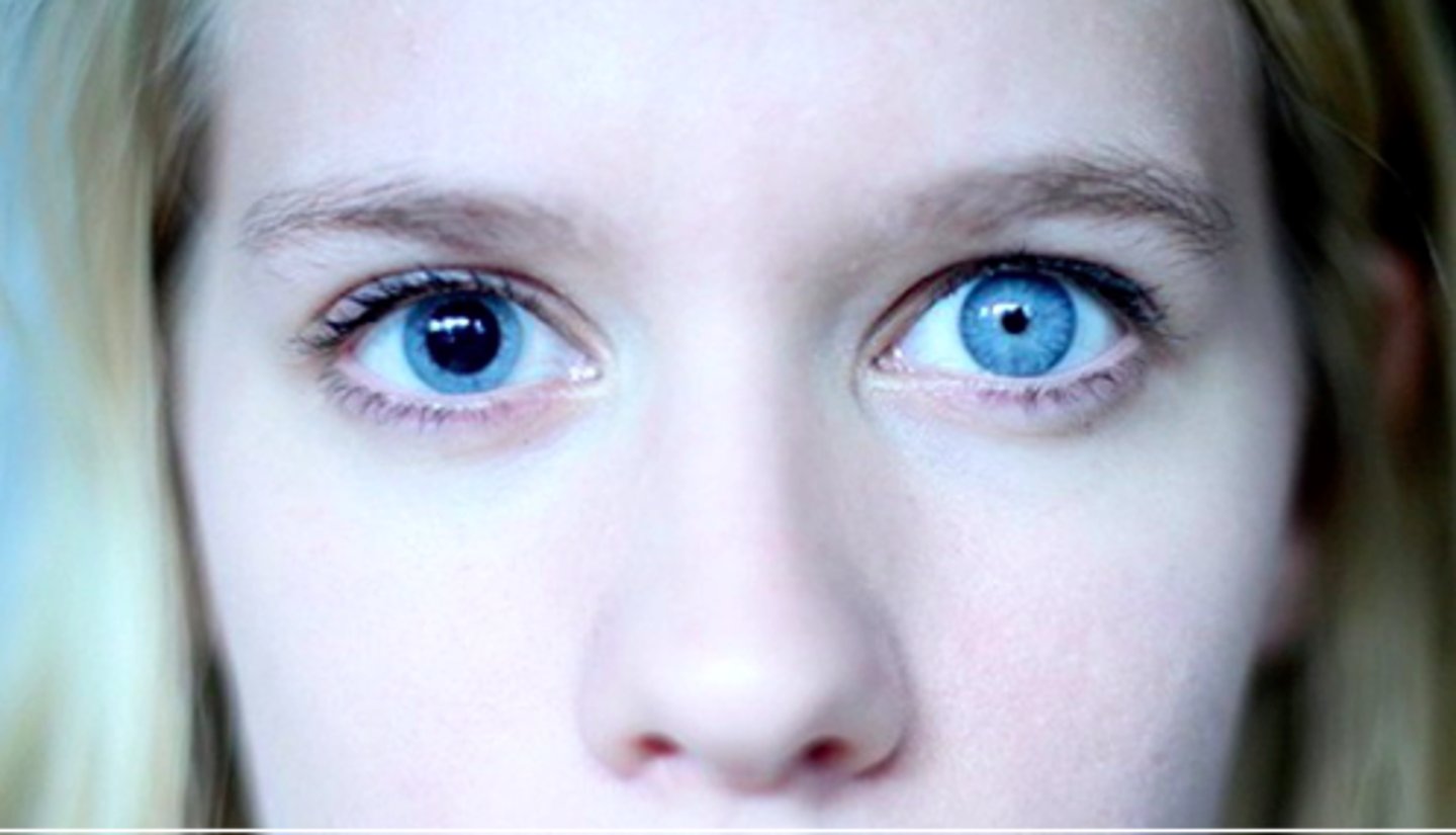 <p>AKA Adies pupil, Holmes-Adie Syndrome</p><p>Caused by impairment of postganglionic parasympathetic innervation to sphincter pupillae muscle or ciliary malfunction</p><p>Dilated pupil - Rare neurological disorder; absent or poor deep tendon reflexes (ex: knee jerk)</p>