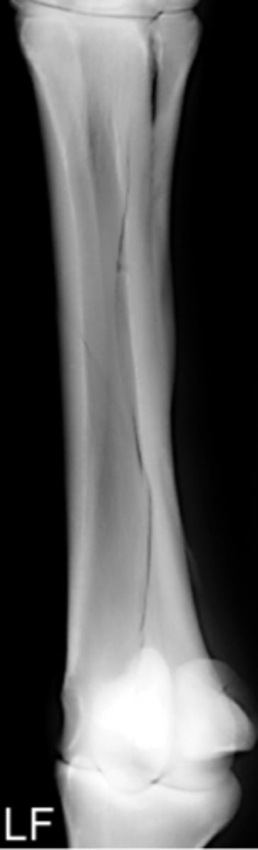 <p>Identify the fracture type?</p>