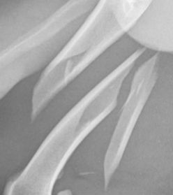<p>Sharp edges with no new bone</p>