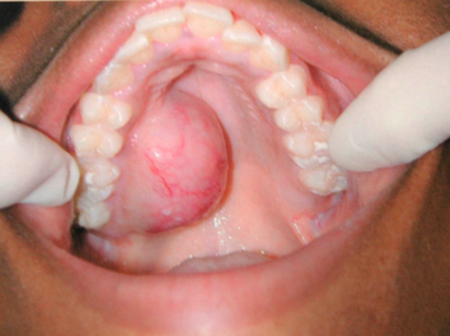 <p>Patient presents with<strong> firm swelling</strong> on the palatal mucosa. Patient is <strong>asymptomatic</strong>. Patient says they noticed the growth, but didn't realize it had gotten so big because it took a while to grow. Histopath report shows<u> well-circumscribed/encapsulated, Double-layered ducts and Plasmacytoid cells</u>. What is the diagnosis?</p>