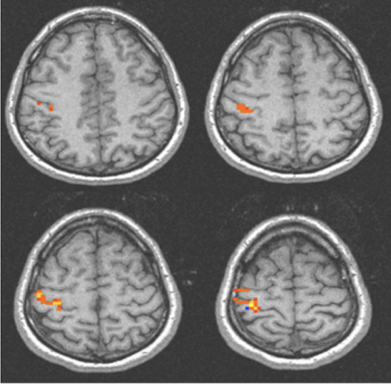 <ul><li><p>Measures brain activity by <strong>identifying changes in blood flow</strong></p><ul><li><p>Brain activity and blood flow linked</p></li></ul></li><li><p><strong>Bold signal</strong></p></li><li><p>System level of the brain</p></li><li><p>All about <strong>structure and function</strong></p></li><li><p>Measuring neural activity in brain by proving <strong>good spatial resolution</strong> but <strong>terrible temporal resolution</strong></p></li><li><p>A little slow → ~1 second</p></li><li><p>Participant tapping finger → fMRI sees primary motor cortex active, able to evaluate bold signal through blood oxygen level → magnet spins biomolecules and blood cells in brain (carrying O2) able to measure spin frequency and determine where there is significant uptake of blood</p></li></ul>