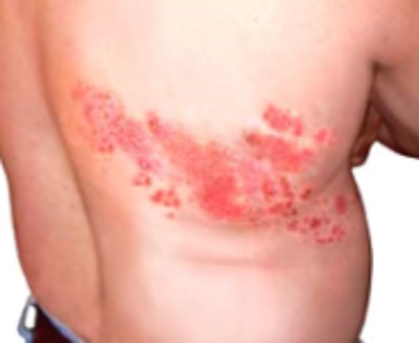 <p>vesicles following a dermatomal pattern</p><p>*look for Hutchinson's sign</p>