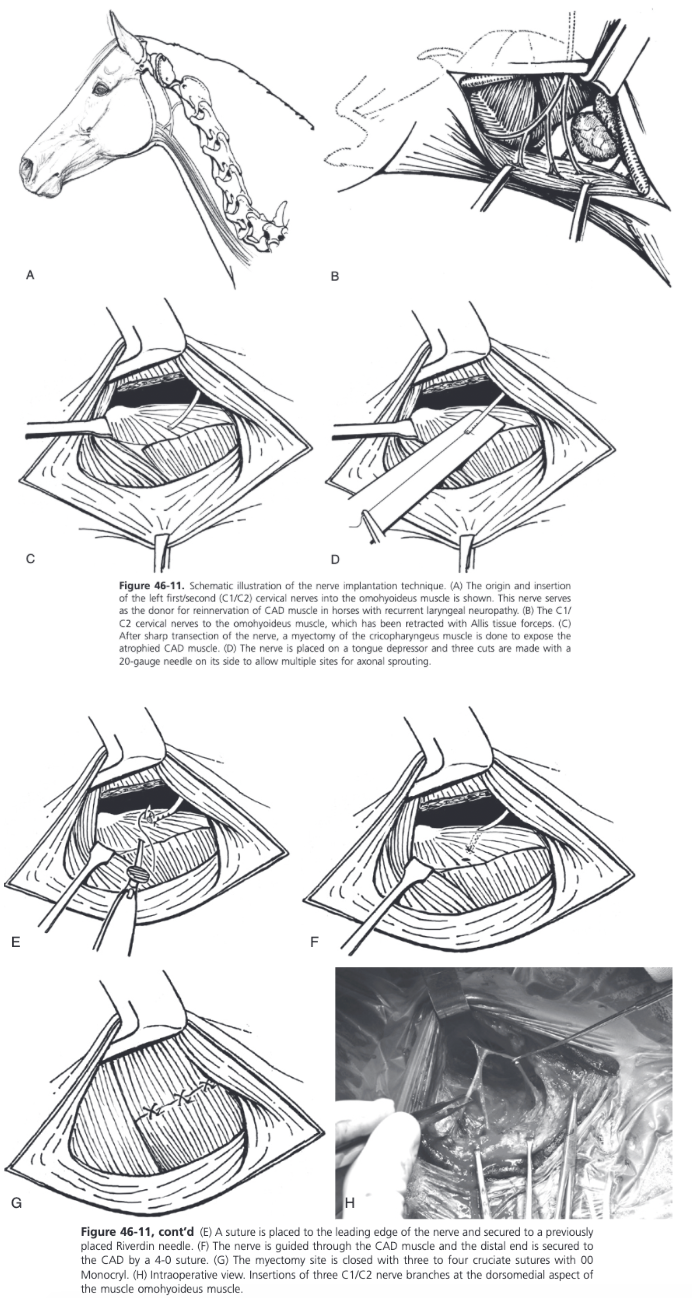 <ul><li><p><span>Surgical instruments should include very small atraumatic thumb forceps, a spay hook, a nerve holding thumb forceps, and small blunt Weitlaner self-retaining retractors in addition to the instruments used for laryngeal surgery</span></p></li><li><p><span>For left RLN, right lateral recumbency and head and neck positioned as for laryngoplasty</span></p></li><li><p><span>12 cm linear incision made along the ventral border of the linguofacial vein, which is carefully separated from the omohyoideus muscle</span></p></li><li><p><span>First cervical nerve usually lies under the linguofacial vein at the caudal half of the incision</span></p></li><li><p><span>Ventral branch of the first cervical nerve emerges through the alar foramen of the atlas, and after joining with branches of the C2 nerve, descends over the caudal aspect of the larynx before dividing into two or three branches as it enters the omohyoideus muscle</span></p></li><li><p><span>Main body of C1/C2 nerve is identified with the help of a single pulse nerve stimulator (1 mA)</span></p><ul><li><p><span>Stimulation of a branch of C1/C2 results in synchronized twitching of the omohyoideus muscle</span></p></li><li><p><span>Insertions of the C1/C2 nerve branches can be found in the dorsomedial aspect of the muscle belly</span></p></li></ul></li><li><p><span>Meticulous dissection to expose the fine branches of the nerve as they enter the omohyoideus muscle</span></p><ul><li><p><span>Exposure is improved by ventral retraction of the omohyoideus muscle using two Allis tissue forceps</span></p></li></ul></li><li><p><span>Middle branch of the nerve often divides into smaller branches and can be traced to a point of muscle entry: one or two branches are identified, gently dissected proximally so they can be implanted without tension in the CAD muscle</span></p></li><li><p><span>Anastomoses with other nerves in the atlantal fossa are preserved</span></p></li><li><p><span>Main branch which, when stimulated, produces the strongest contraction of the OH is selected</span></p></li><li><p><span>This branch is gently elevated using a spay hook or a nerve holding thumb forceps and is freed from its fascial attachments on the lateral aspect of the larynx</span></p></li><li><p><span>The distal end of the nerve is cut with a fresh 15 blade</span></p></li><li><p><span>One additional smaller branch is usually freed and cut similarly</span></p></li><li><p><span>End of the nerve is wrapped in a saline soaked sponge</span></p></li><li><p><span>Thyropharyngeus and cricopharyngeus muscles are bluntly separated</span></p></li><li><p><span>Rostral two-thirds of the cricopharyngeus muscle are clamped using long Satinsky forceps and sectioned transversally to expose the CAD</span></p></li><li><p><span>A 4-0 suture nylon is placed in the distal end of the nerve to allow implantation of the nerve</span></p></li><li><p><span>To facilitate multiple sprouting areas of the nerve, it is placed on a tongue depressor and three small cuts are made along the distal 15 mm of the nerve with the bevel of a 20 gauge needle</span></p></li><li><p><span>Larynx is rotated laterally by placing a spay hook on the thyroid lamina and a Reverdin needle is passed from lateral to medial in the midbody of the CAD</span></p></li><li><p><span>The suture is secured to the needle</span></p></li><li><p><span>The nerve is implanted within the CAD tunnel by retraction of the needle</span></p></li><li><p><span>Suture is cut and another 4.0 suture is placed in the epineurium of the distal end of the nerve</span></p></li><li><p><span>Suture is then guided back inside the lateral end of the tunnel and sutured to the lateral belly of the CAD muscle, approximately 5 mm medial to the exit point of the nerve</span></p></li><li><p><span>The exit point of the nerve medially is retracted by a nerve hook so that the nerve and its three cut ends are located within the belly of the CAD muscle</span></p><ul><li><p><span>Alternatively, the small transverse cuts at the distal part of the nerve can be performed after tunneling the nerve through the CAD, just before suturing</span></p></li></ul></li><li><p><span>Any excess nerve branch is implanted directly in a small slit in the lateral muscle belly of the CAD as described</span></p></li><li><p><span>Partial myotomy of the cricopharyngeus is then closed with three simple cruciate patterns</span></p></li></ul>