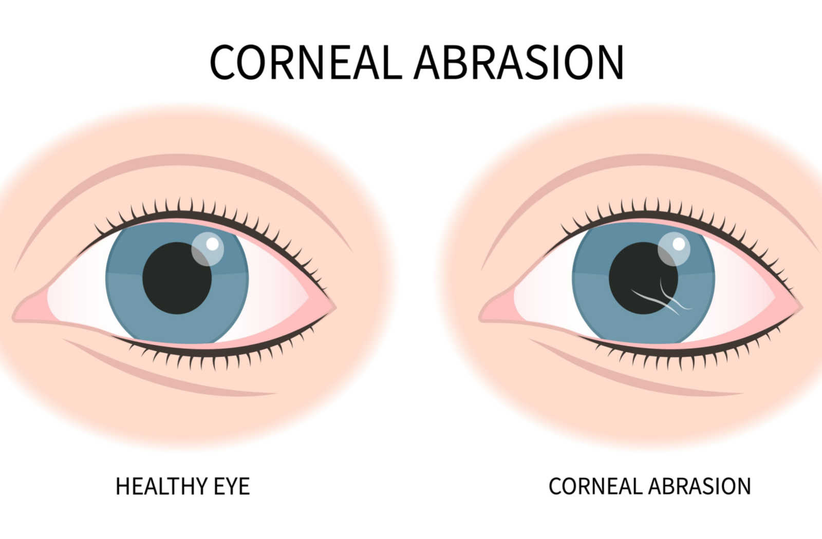 <p>PP: injury to cornea→diffuse conjunctival injection</p><p>E: abrasions<br>injuries<br>viral<br>bacterial</p><p>CM: moderate-severe+superficial pain<br>decreased vision<br>watery/purulent discharge<br>pupil not affected (unless iritis develops)<br>infection→corneal opacity+epithelial defect</p>