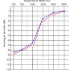 <p>What Paitient is this? kind of hearing loss do they have?</p>