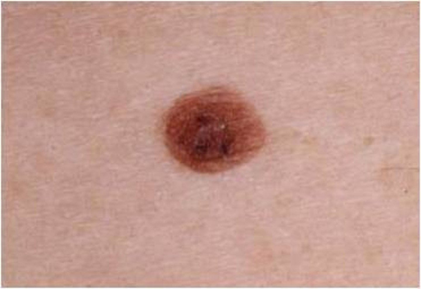 <p>Mole </p><p>Symmetrical, flesh-colored, tan-brown macule or papule </p><p>Located anywhere</p>