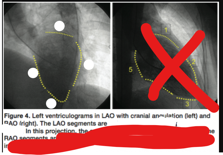 <p>label the heart surface in this LAO angiographic image</p>
