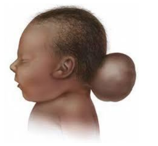 <p>part of skull improperly formed, part of the brain is outside (often part of a syndrome) </p>