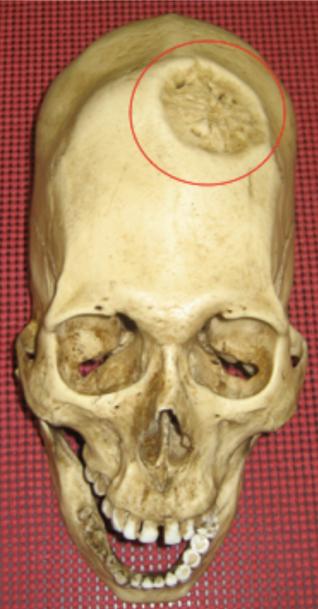 <p><span>Is this injury antemortem, perimortem, or postmortem?</span></p>