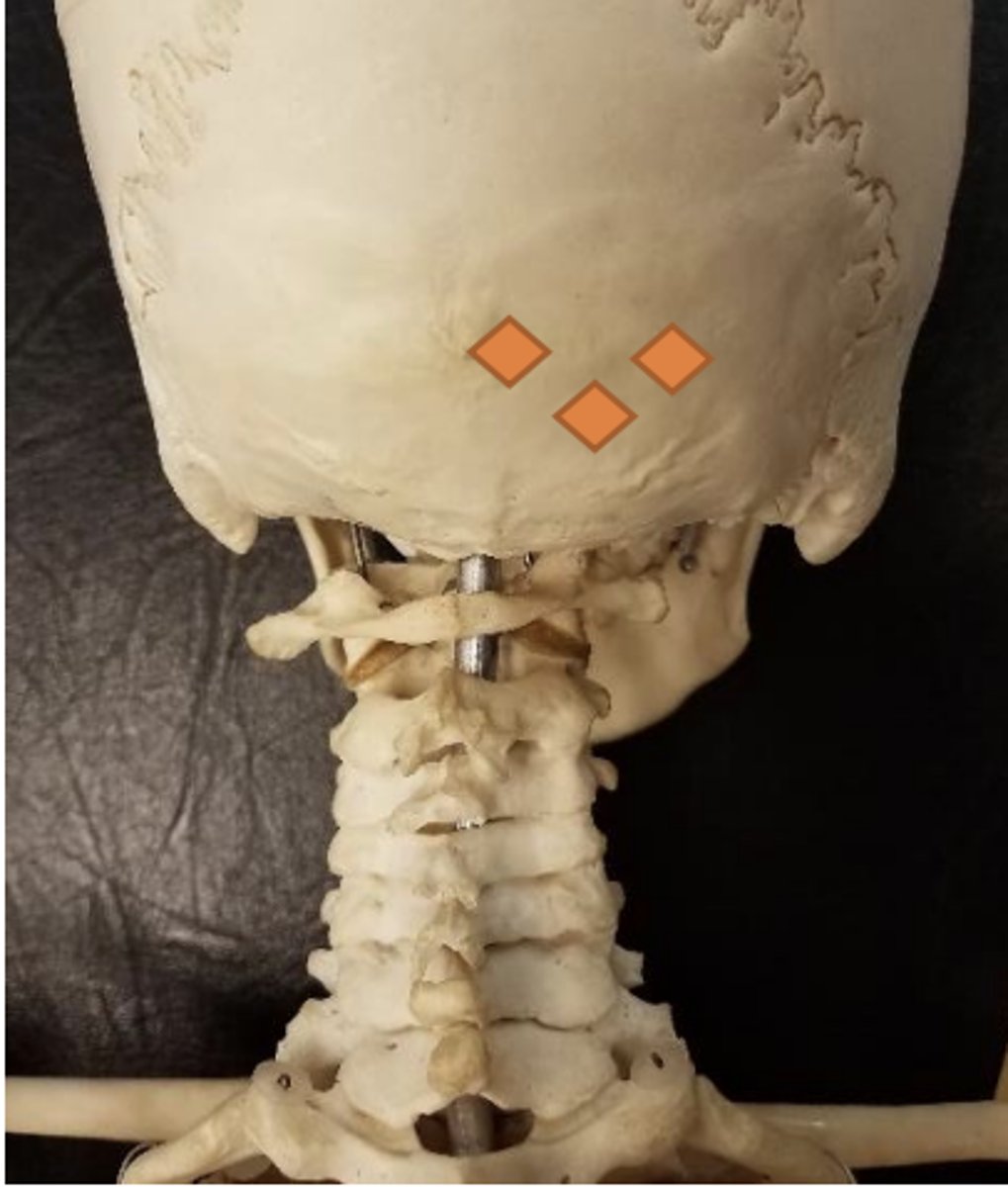 <p>inion (inferolateral)</p>