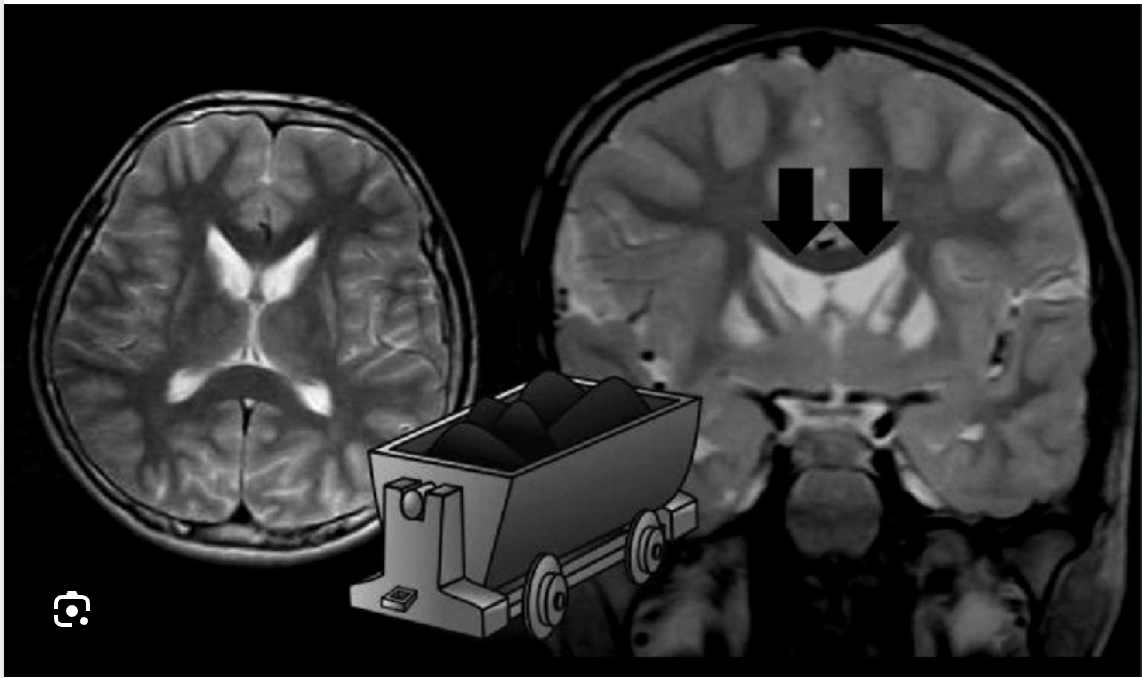 <p>What might you see on MRI/CT for Huntingtons?</p>