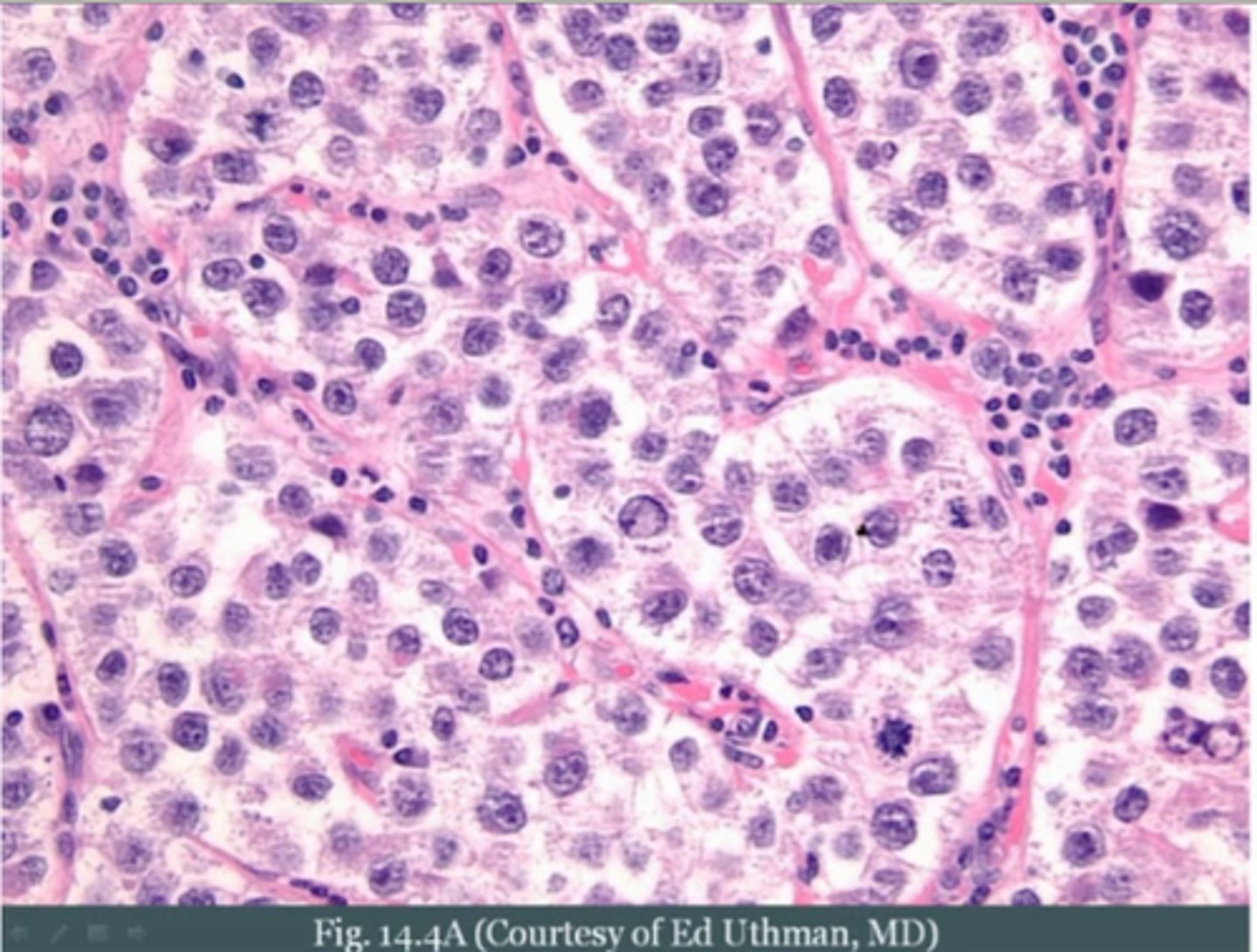 <p>A disease caused by a germ.</p>