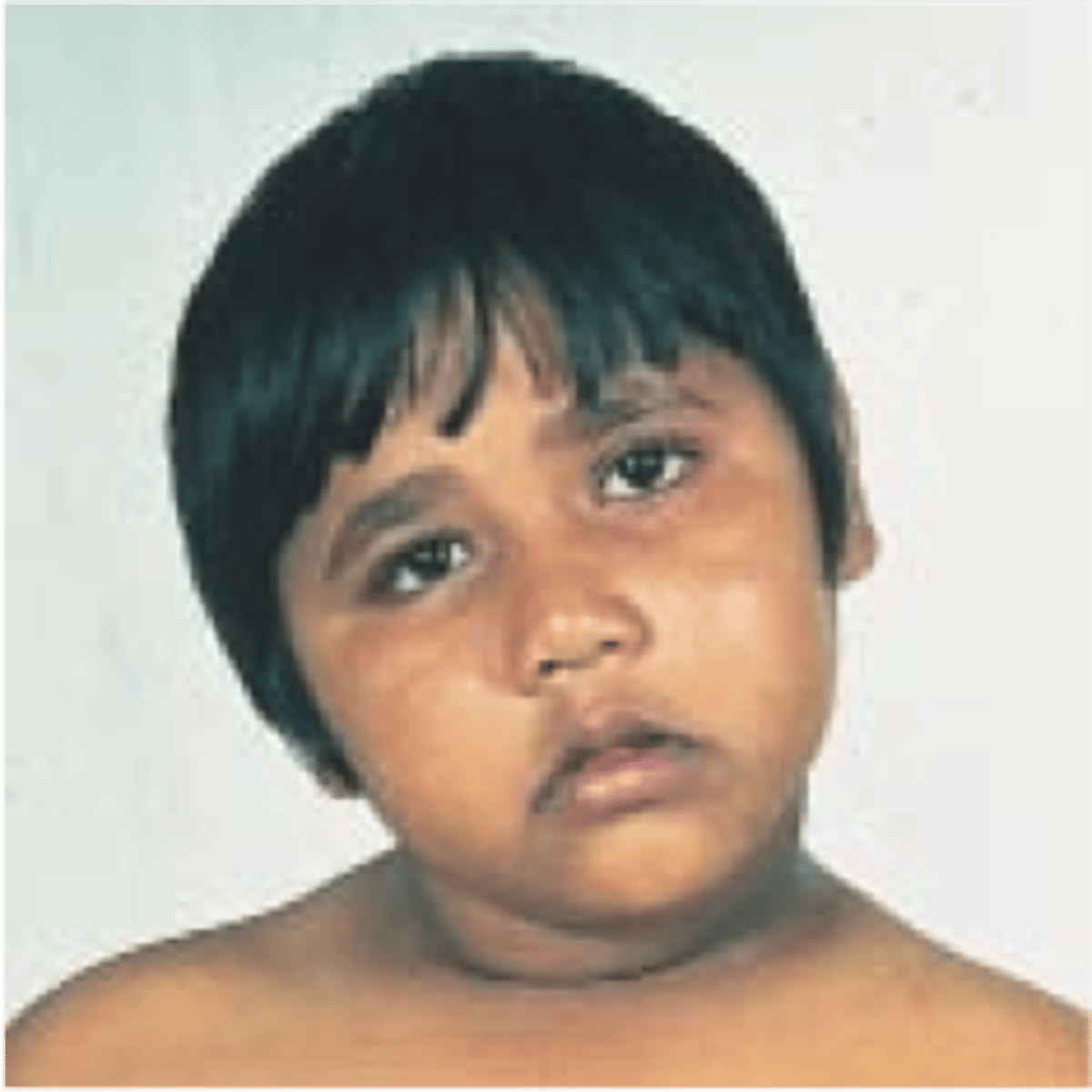 <p>Limited ROM of the neck, characterized by holding the head to one side.</p>