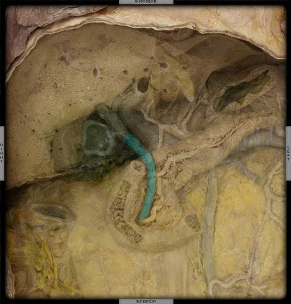 <p>A duct formed by the hepatic and cystic ducts, , The duct that carries bile from the gallbladder and liver to the small intestine (duodenum).</p>