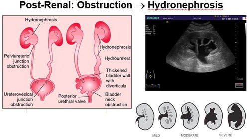 -urinary tract *obstruction* affecting both kidneys causing back pressure to bowman's space- afferent arteriole can dilate to compensate but will fail --> under perfused areas of the renal cortex and decrease of GFR
•Ureteric: caliculi, blood clots, papillary necrosis, cancer, external compression
•Bladder: neurogenic bladder, BPH, caliculi, blood clots, cancer
•Intratubular crystallization: uric acid, Ca oxalate, acyclovir, sulfonamide, methotrexate