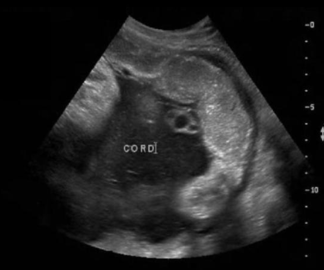 <p>what grade is the placenta</p><p>a) 0</p><p>b) 1</p><p>c) 2</p><p>d) 3</p>