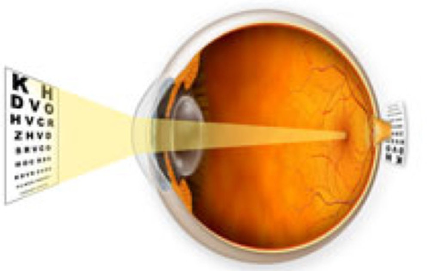 <p>Condition where light focuses behind the retina</p>