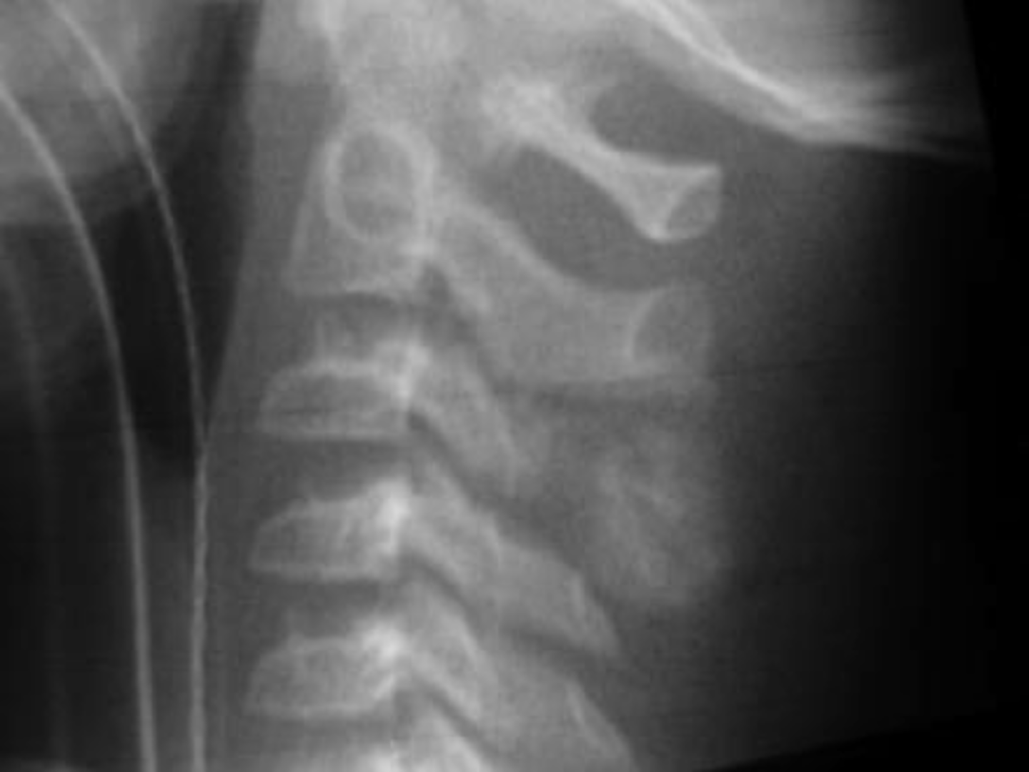 <p>- 10-20 y.o. (3-78 y.o. reported)</p><p>- M:F, 2:1</p><p>- Spine</p><p>• Painful scoliosis</p><p>• Posterior elements</p><p>- Femur, foot, ankle</p><p>• Nidus &gt;2cm</p>