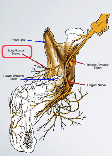 <p>long buccal nerve block</p>