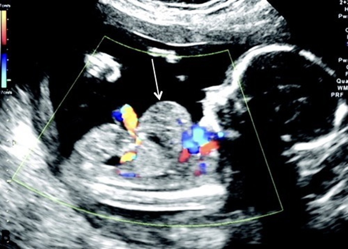 <p>Consists of 5 Defects:</p><p>Cleft sternum</p><p>Diaphragmatic hernia</p><p>Upper anterior wall defect</p><p>Cardiac defects -> ectopic cordsis (heart outside body) Pericardial defect -> creates pericardial/pleural effusion</p>