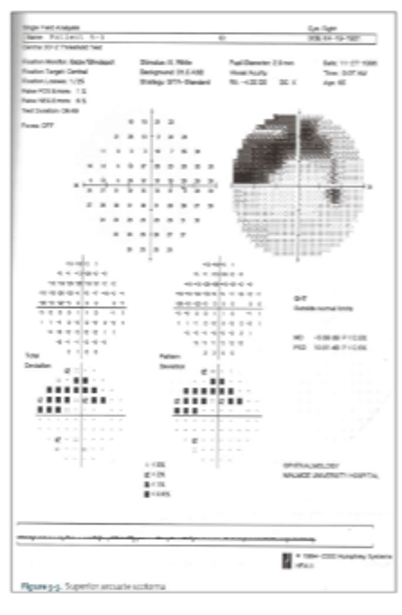 <p>Bjerrum scotoma</p>