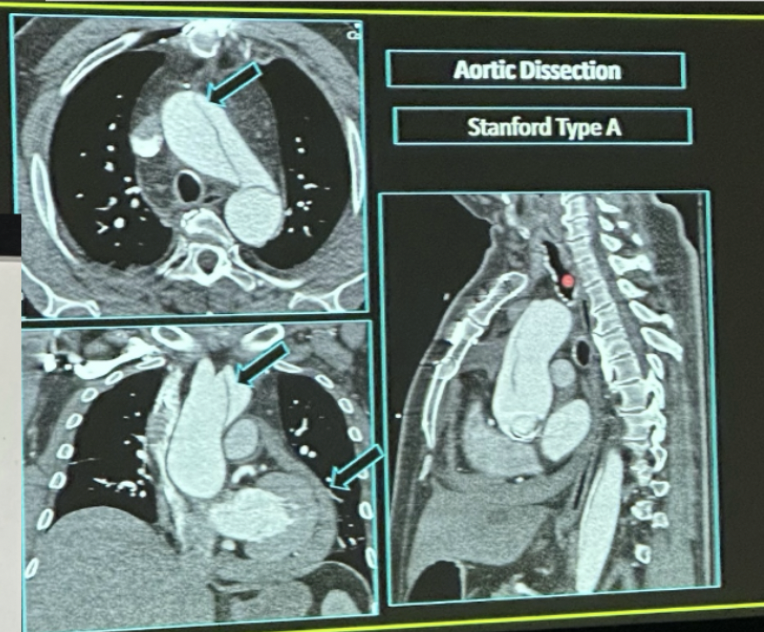 <p><em>Stanford classification of Aortic Dissection</em></p>