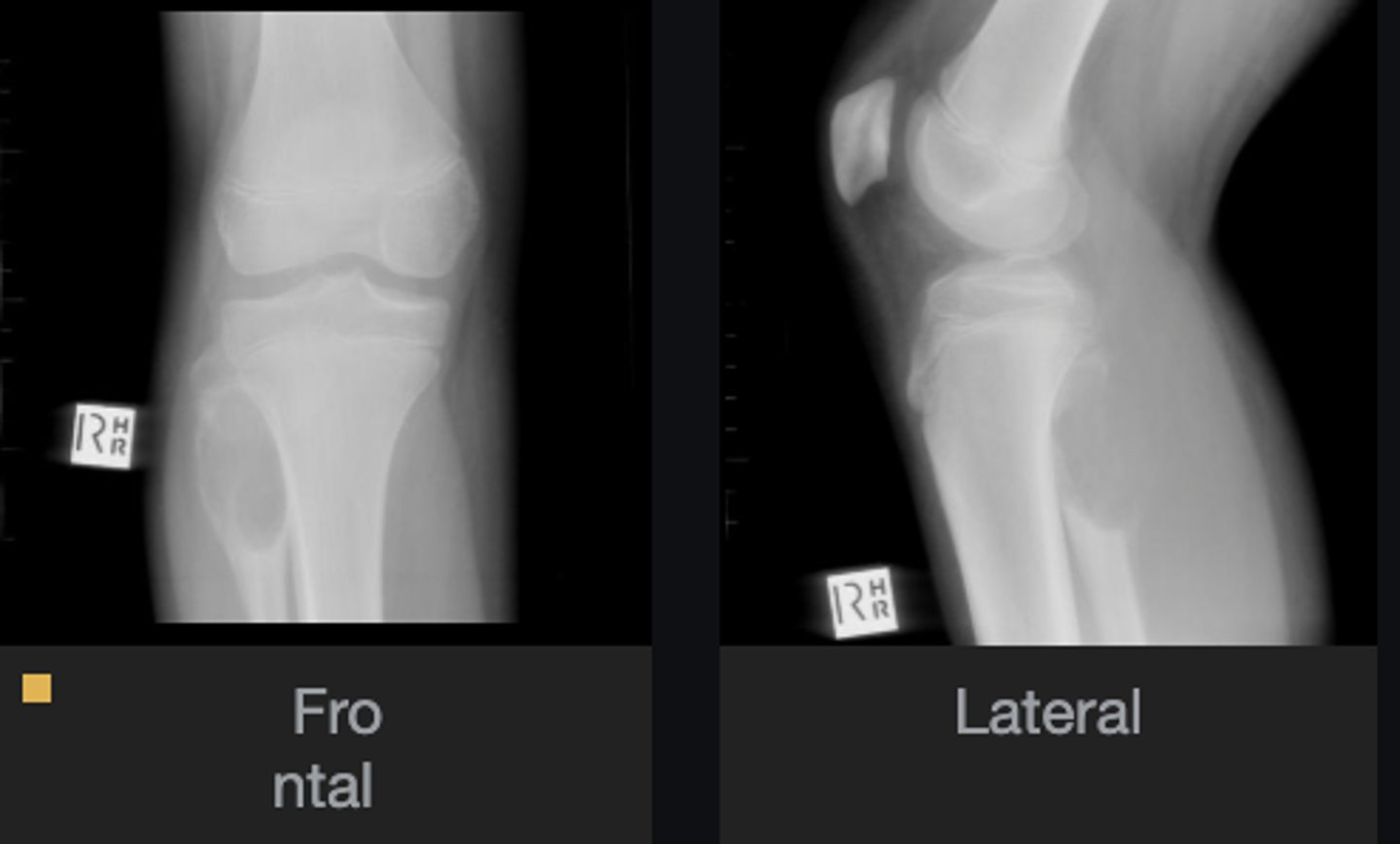 <p>Most likely diagnosis?</p>