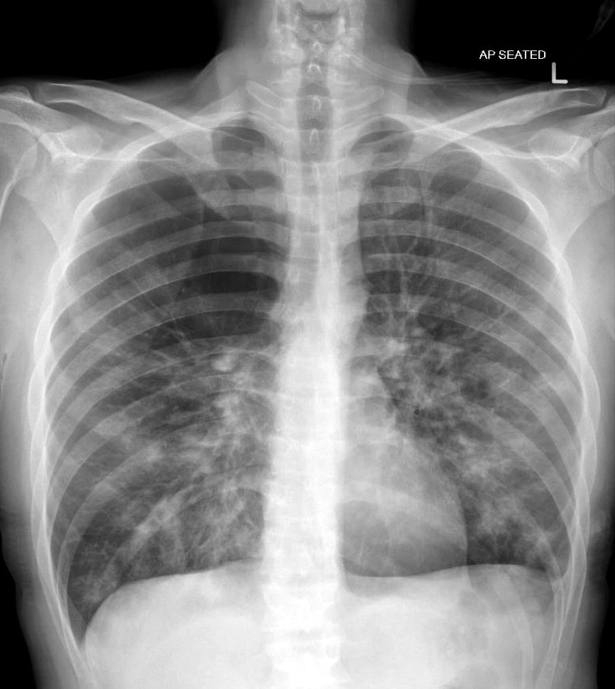 <p>-Destructive and obstructive airway changes leading to an increased volume of air in the lungs</p><p>-comes from the greek word emphysema which means to inflate or swell which is what happens to the alveoli in this condition which causes the increase of air</p>