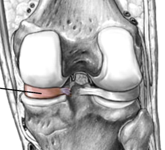 <p>Which part of the knee is a large pad that sits between the femur and tibia on the medial side?</p>