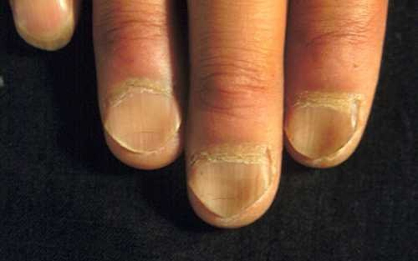 <p>Spoon nails, seen in severe iron deficiency</p>