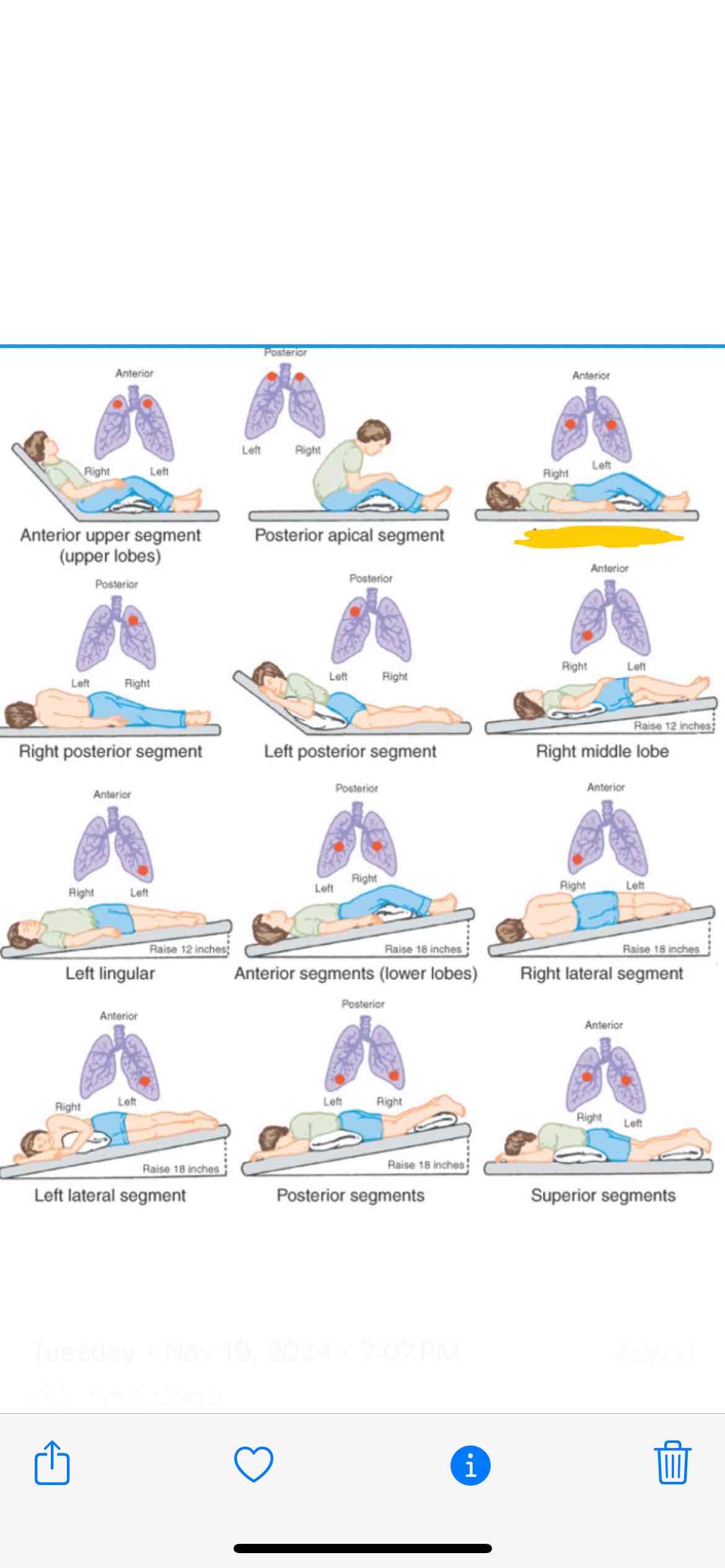 <p><span>Which lung segment does this position effect</span></p>