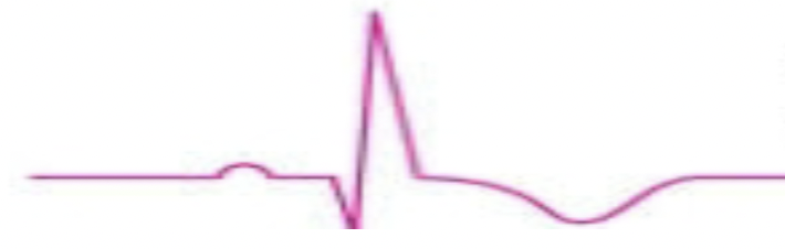 <p>What is the rhythm?</p>