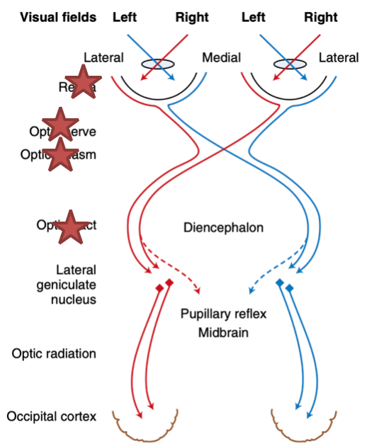 <p>Involved the collection / distribution system </p><p>Will see lesions in the:</p><ul><li><p>Eye</p></li><li><p>Optic nerves</p></li><li><p>Optic chiasm</p></li><li><p>Optic tract</p></li></ul><p></p><p>Clinical signs:</p><ul><li><p>ABSENT PLR </p></li><li><p>ABSENT menace response </p></li><li><p>Blind </p></li></ul><p></p>
