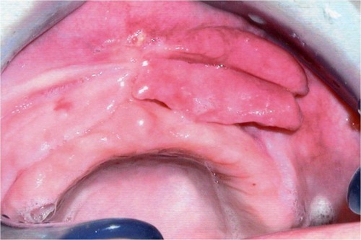 <p>Reactive hyperplasia due to an ill-fitting denture or alveolar resorption, clinically is often found in the vestibules with redundant folds, often rubbery, may be ulcerated with an overgrowth of tissue around the border of a denture. Its treated with excision (with histopathologic examination of the tissue) and/or a remake or reline the denture</p>