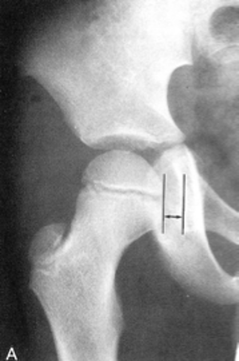 <p>Clinical significance of a small Kohler's teardrop distance</p>