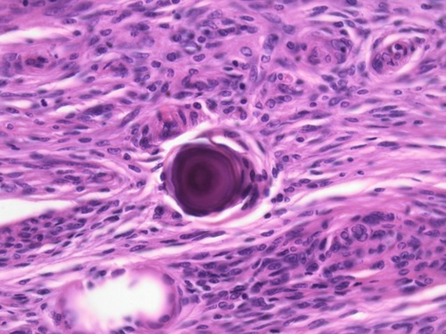 <p>distinct histological finding of prolactinomas</p>