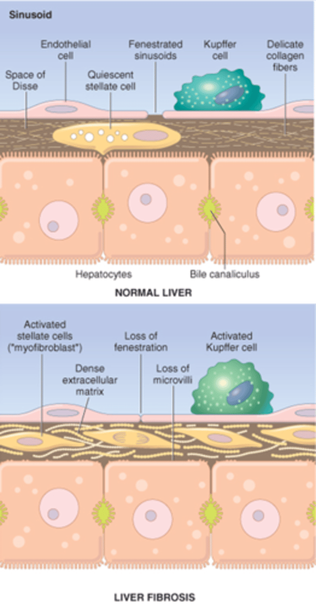 <p>1. Alcohol absorbed from stomach &gt; acetaldehyde, toxic to liver cells.</p><p>2. Slowly progressive &gt; chronic liver failure.</p><p>3. Hepatocytes die &gt; scarring &gt; damage between cells and bile system. Cells still function but reduced and eventually demand takes over supply &gt; liver failure.</p><p>4. Ends in hepatic coma or complications of portal hypertension. </p>