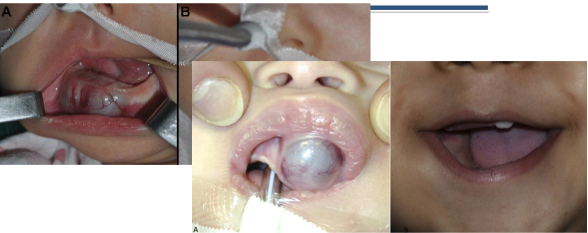 <ol><li><p>90% in the head + neck within the first 6 months </p></li><li><p>60% on the palatal mucosa</p></li><li><p>brownish-red mass of alveolar mucosa</p></li><li><p>high levels of vanillylmandelic acid in urine</p></li></ol><p></p>