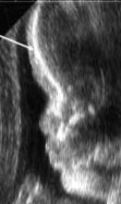 <ol><li><p>What is abnormal about this image?</p></li><li><p>This finding can be associated with what pathologies?</p></li></ol><p></p>