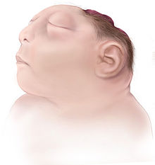 <p>Anencephaly</p>